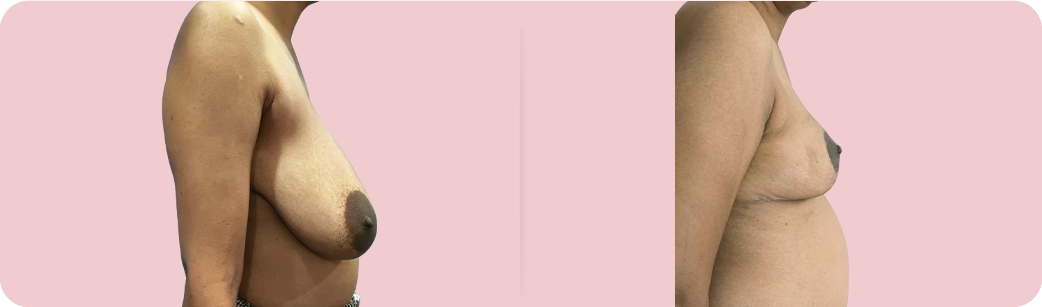 Breast Reduction 11