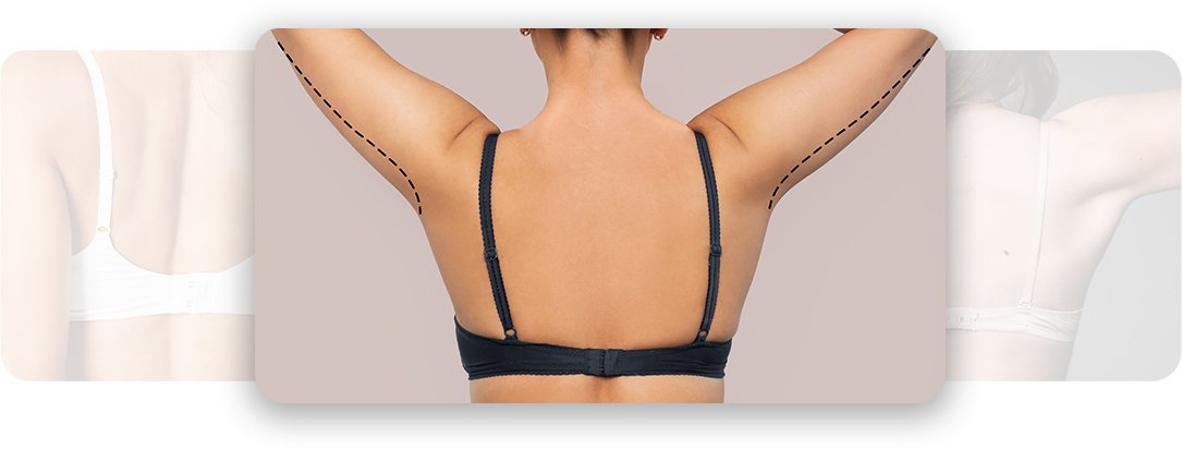 Bra line Backlfit - AEONA Aesthetic Clinic