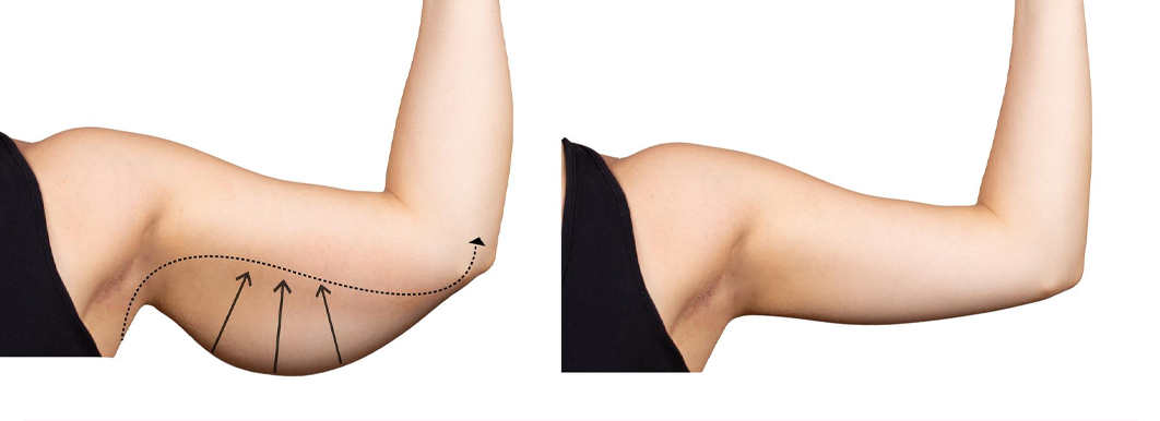 Brachioplasty Techniques