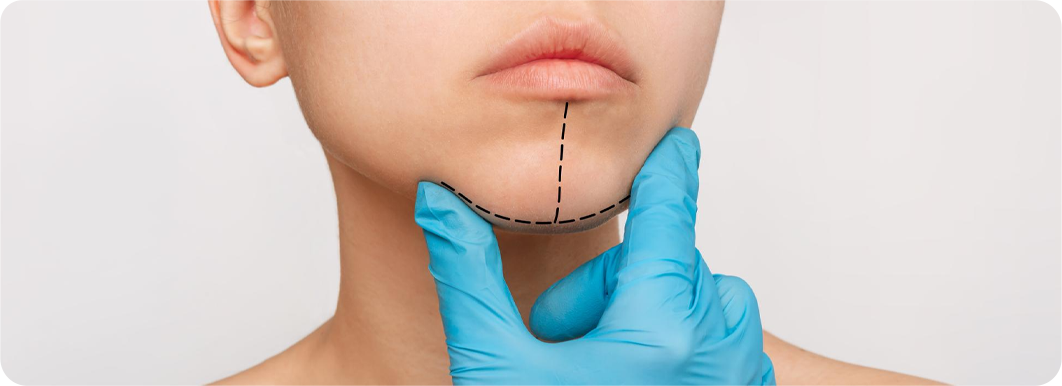 Chin Implant Techniques