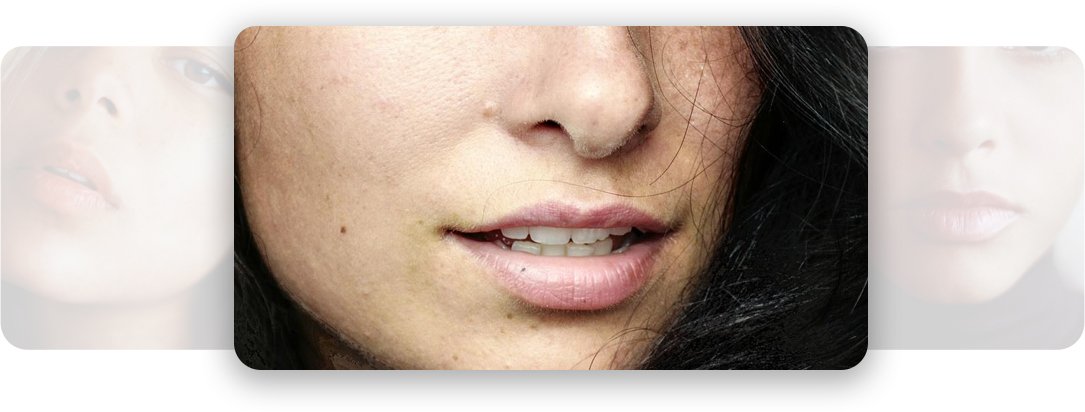 Lip Lift Surgery - AEONA Aesthetic Clinic