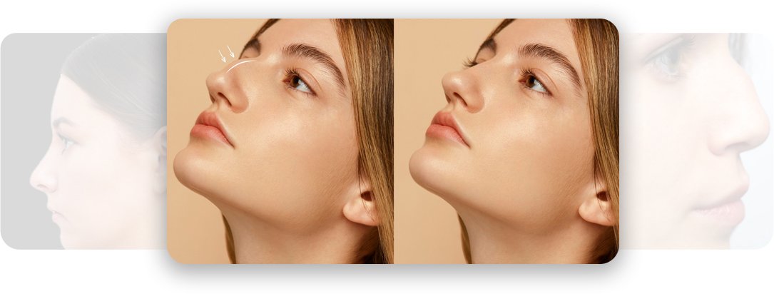 Nose Makeover - AEONA Aesthetic Clinic