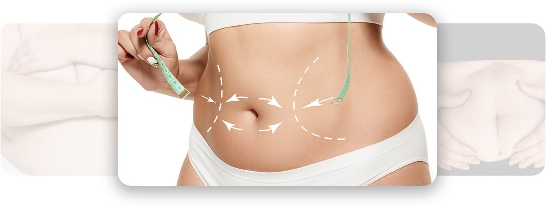 Mommy Makeover - AEONA Aesthetic Clinic