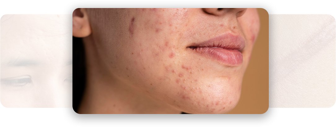 Scar Revision - AEONA Aesthetic Clinic