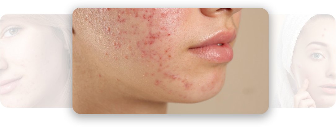 Acne - AEONA Aesthetic Clinic