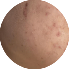 Moderate Acne