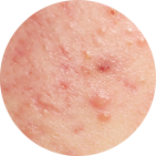 Moderately Severe Acne