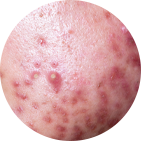 Severe Acne