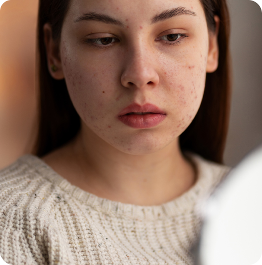 Why Women Choose Microneedling?