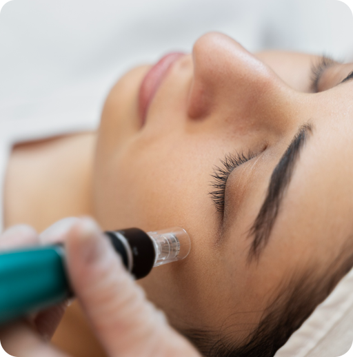 Microneedling