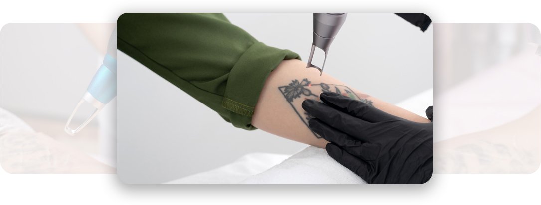 Tattoo Removal - AEONA Aesthetic Clinic