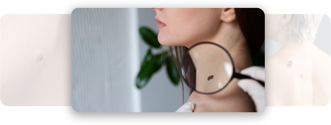 Wart Removal - AEONA Aesthetic Clinic