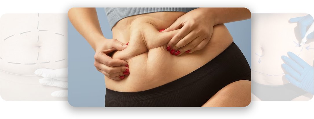 Tummy Tuck - AEONA Aesthetic Clinic