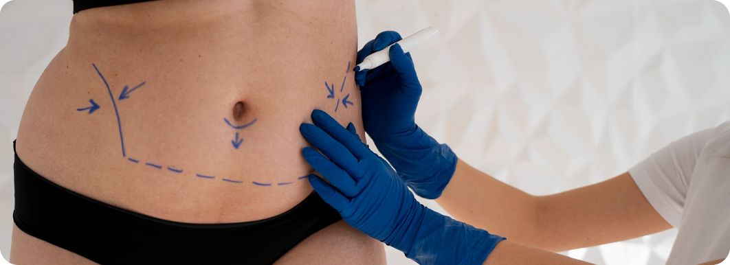 Post Weight loss Treatment