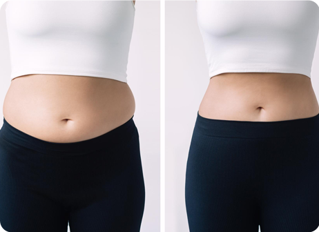 Tummy Tuck or Liposuction